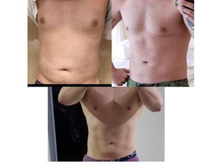 Marcación Abdominal