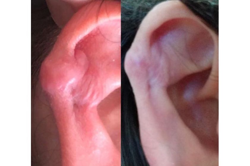 Eliminar cicatrices antes y después - 689032