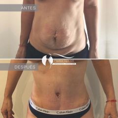 Abdominoplastia - Dr. Diego Cunille