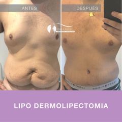 Dermolipectomía - Dr. Diego Cunille