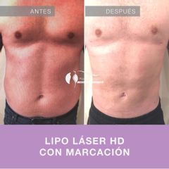 Liposucción - Dr. Diego Cunille