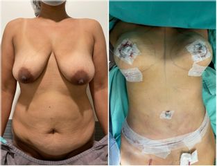 Mastopexia + Abdominoplastia - Dr. Diego Cunille