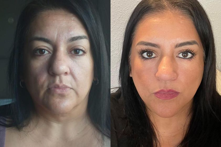 Rejuvenecimiento facial antes y después - 817040