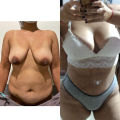 Liposucción - Dr. Diego Cunille
