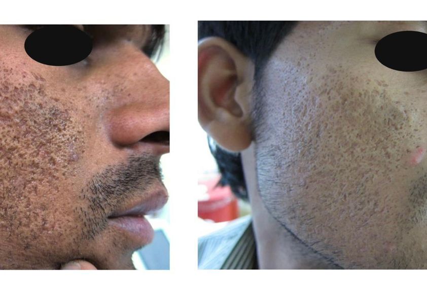 Láser CO2 antes y después - 829658