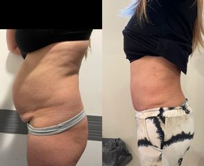 Abdominoplastia - Dr. Diego Cunille