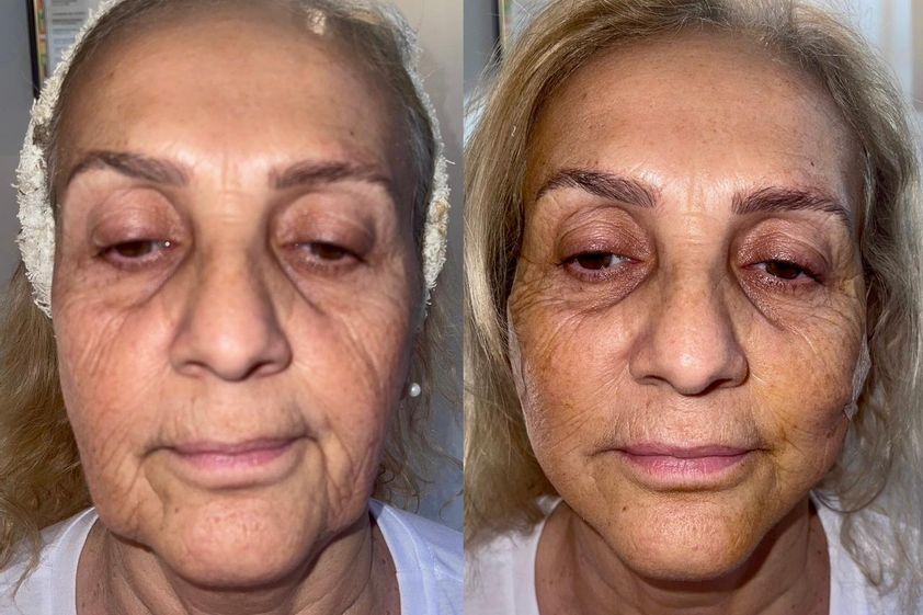 Hilos tensores antes y después - 846786