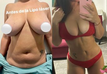 Lipoláser - Dr. Diego Cunille