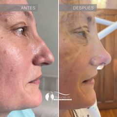 Rinoplastia - Dr. Diego Cunille