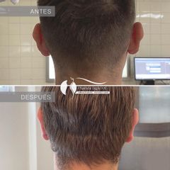 Otoplastia - Dr. Diego Cunille