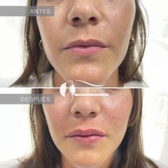 Rellenos faciales - Dr. Diego Cunille