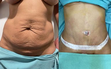 Abdominoplastia - Dr. Diego Cunille
