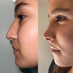 Rinoplastia - Dr. Diego Cunille