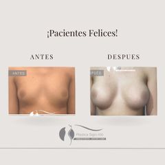 Aumento mamas - Dr. Diego Cunille