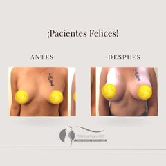 Aumento mamas - Dr. Diego Cunille