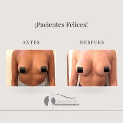 Aumento mamas - Dr. Diego Cunille