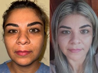 Lifting antes y después - 874875