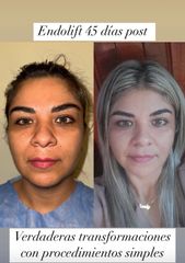 Endolfit - Dr. Diego Cunille