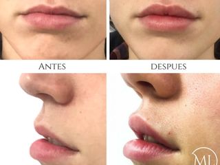Relleno de Labios - Antes y Depues