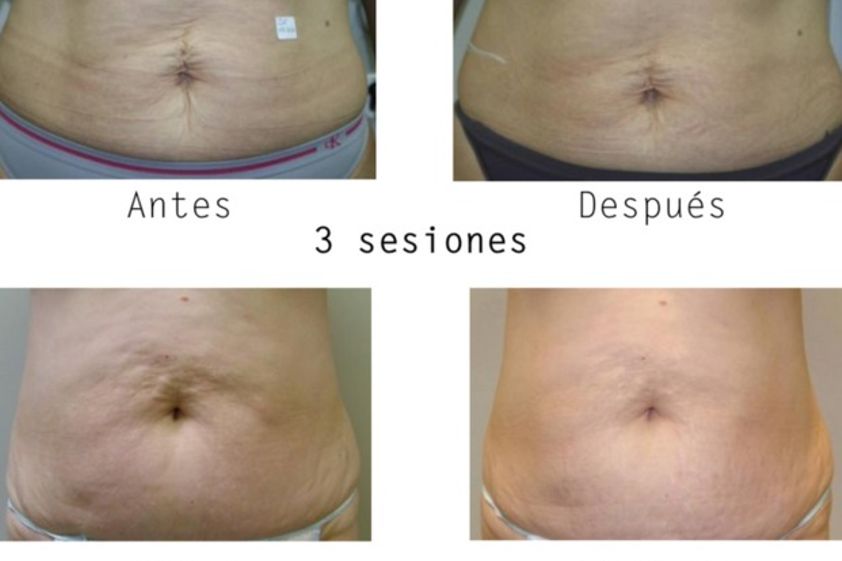 Tratamientos celulitis antes y después - 600158