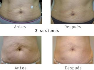 VelaShape 