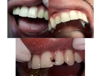Prótesis dentales - 645262