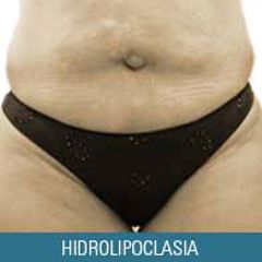 Hidrolipoclasia