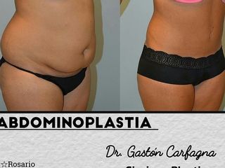 Abdominoplastia