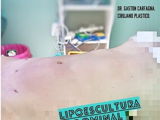 Lipoescultura abdominal