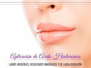 Acido Hialuronico para perfilado o rellenos de labios