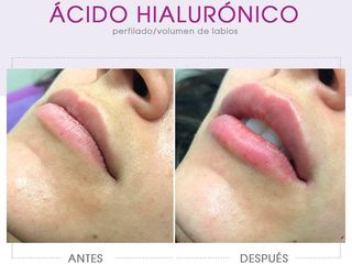 Acido Hialuronico en Labios