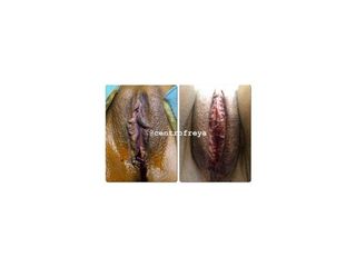 labioplastia3