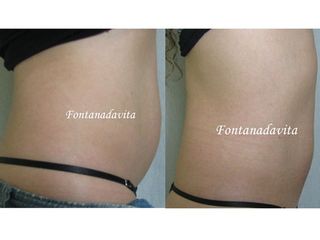 Adiposidad abdominal