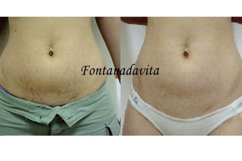 Tratamientos para estrías antes y después - 488222