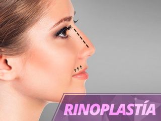 Rinoplastia