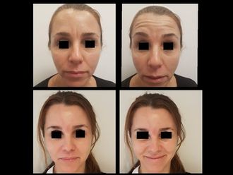 Botox - 629288