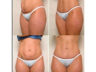 dr donati antes y despues abdomiplastia