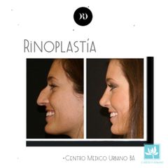 Rinoplastía - Dr. Donati