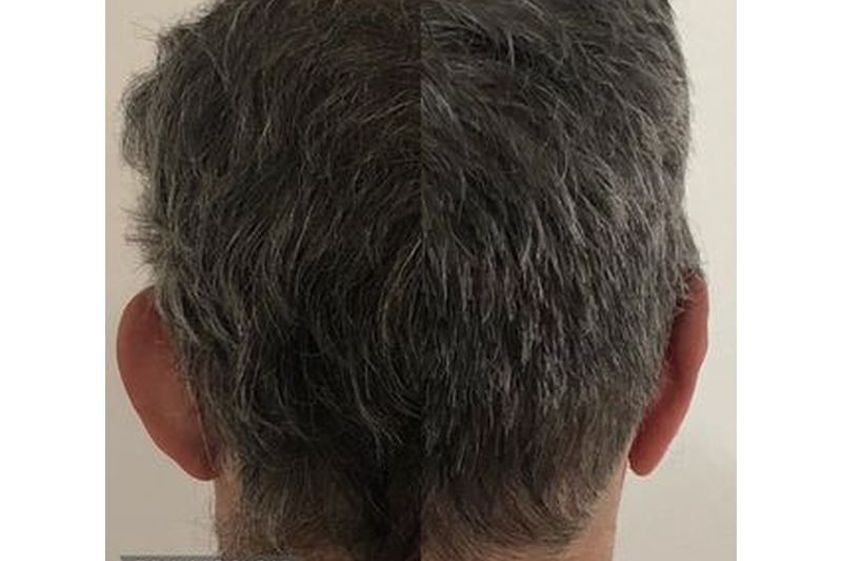 Otoplastia antes y después - 817392