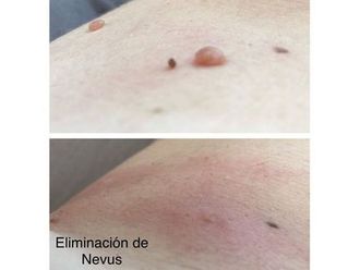 Lunares antes y después - 817396