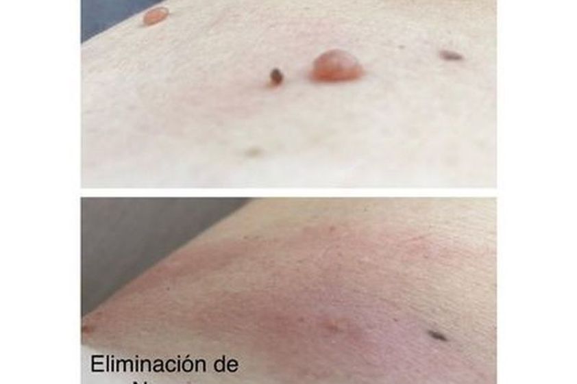 Lunares antes y después - 817396