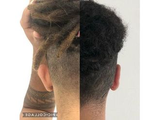 Otoplastia antes y después - 817400