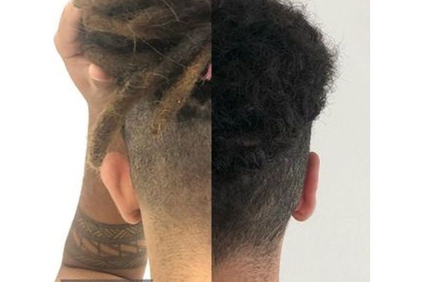 Otoplastia antes y después - 817400