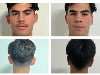 Otoplastia antes y después - 852495