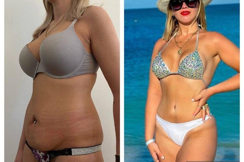 Liposucción antes y después - 852499