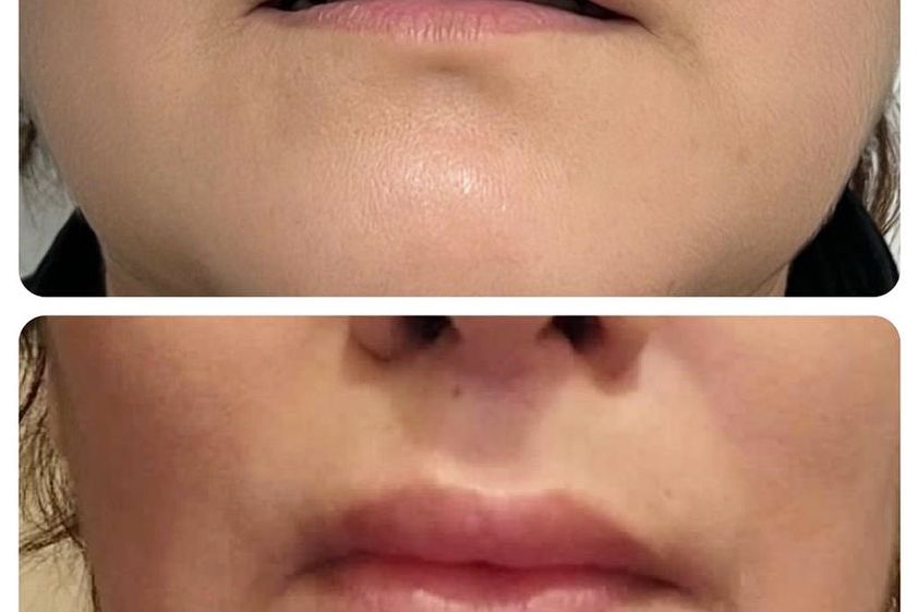 Relleno de labios antes y después - 867023