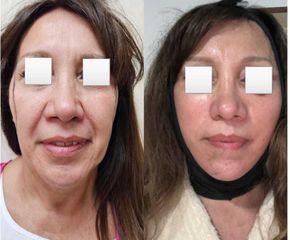 Lifting Facial - Dr. Matias Llabres