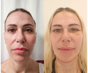 Lifting Facial - Dr. Matias Llabres