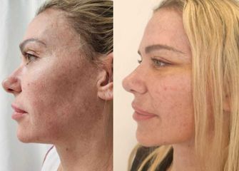 Lifting Facial - Dr. Matias Llabres