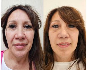 Lifting Facial - Dr. Matias Llabres